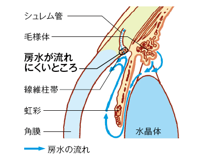 眼の拡大断面図(原発開放隅角緑内障)