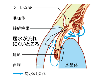 眼の拡大断面図(原発閉塞隅角緑内障)