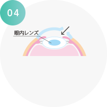 眼内レンズを 入れる